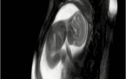 怀孕几个月有胎动