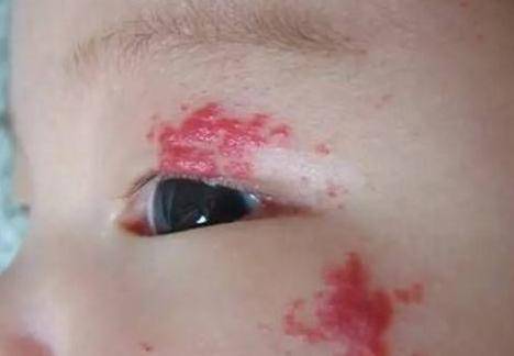 血管瘤