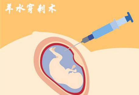 唐氏综合征
