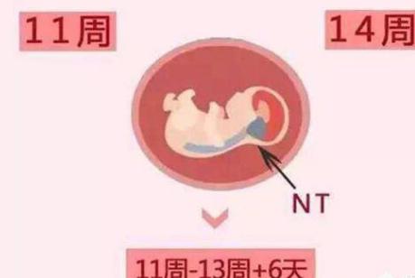 唐氏综合征