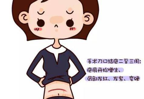 剖腹产