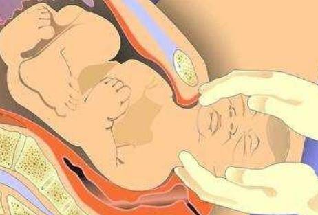 剖腹产