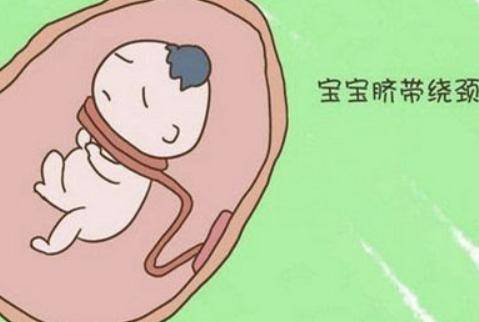 脐带绕颈