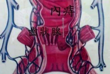 产后痔疮