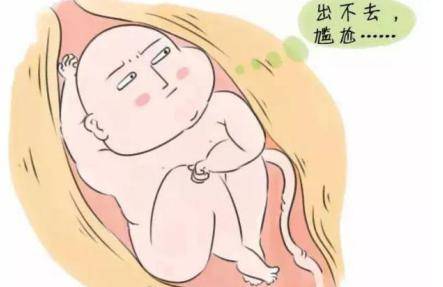 剖腹产