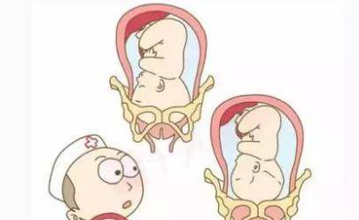 剖腹产