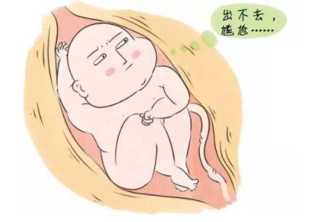 巨大胎儿